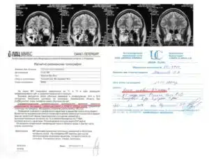 Jonge vrouw leed 9 jaar lang aan chronische migraine MRI -bevinding voor migraine
