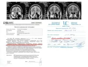 MRI -bevinding voor migraine